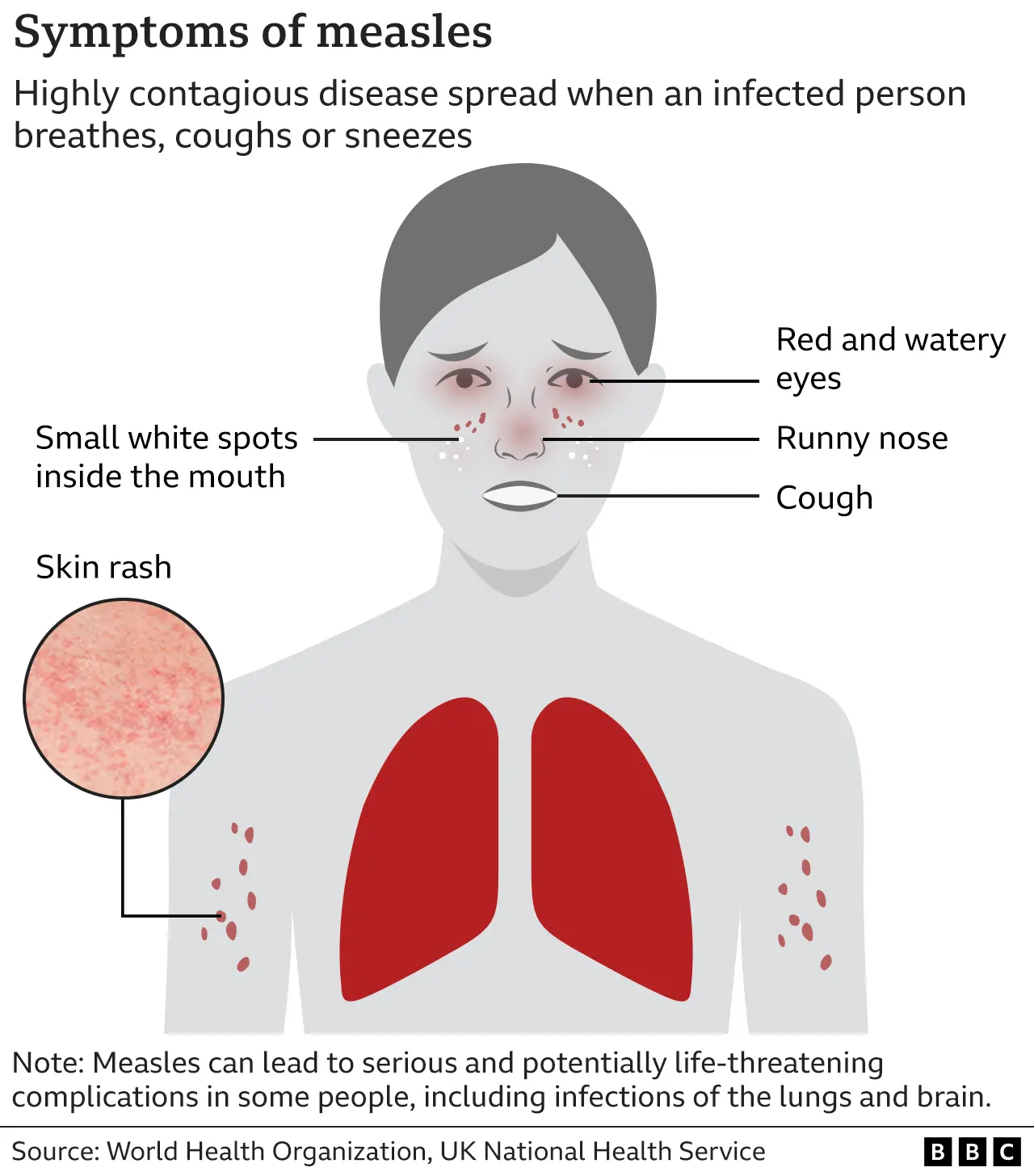 2025 Measles Cases In Virginia: Second Infection Confirmed 2025 Measles Cases In Virginia: Second Infection Confirmed