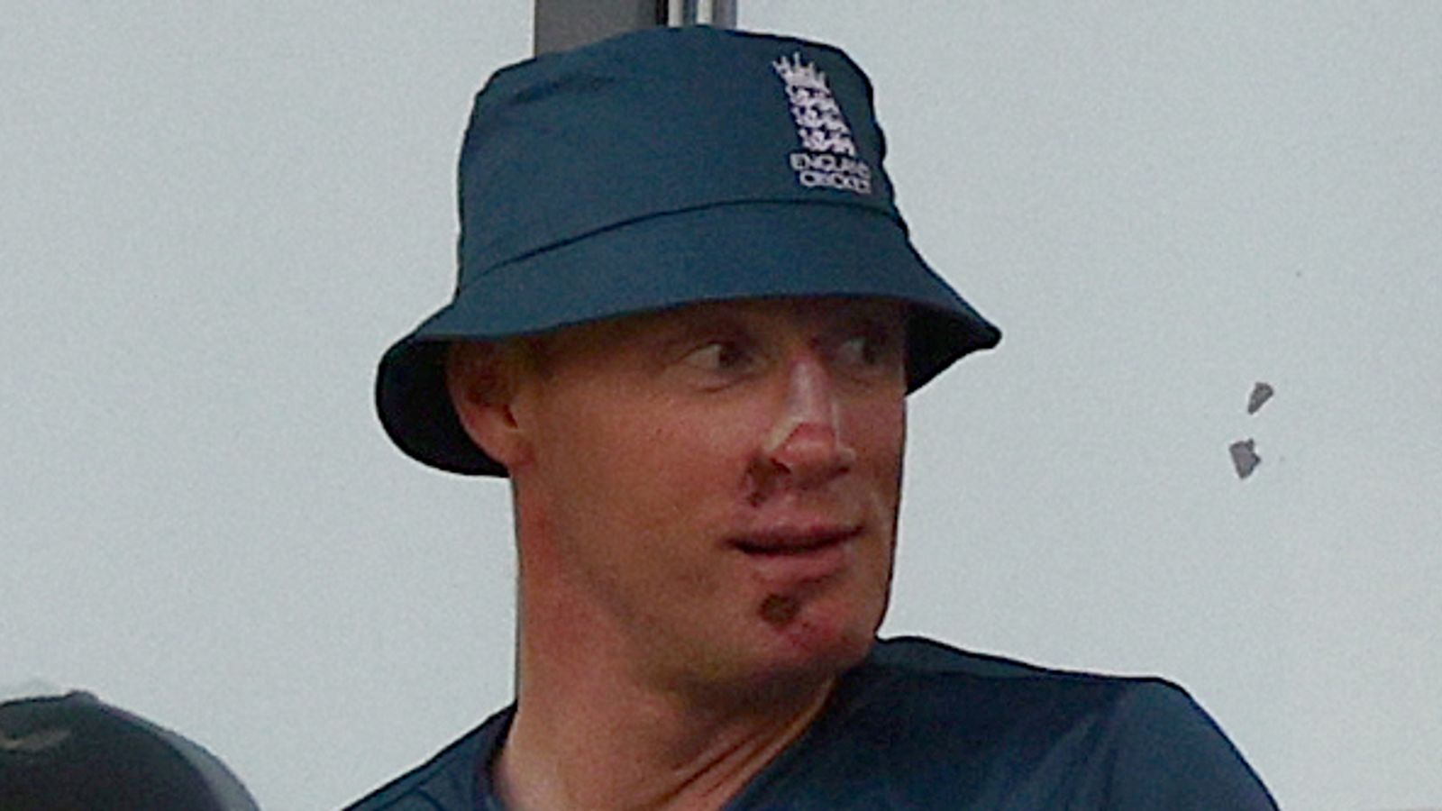 Flintoff's Face After Top Gear Crash: Update On His Recovery Flintoff's Face After Top Gear Crash: Update On His Recovery