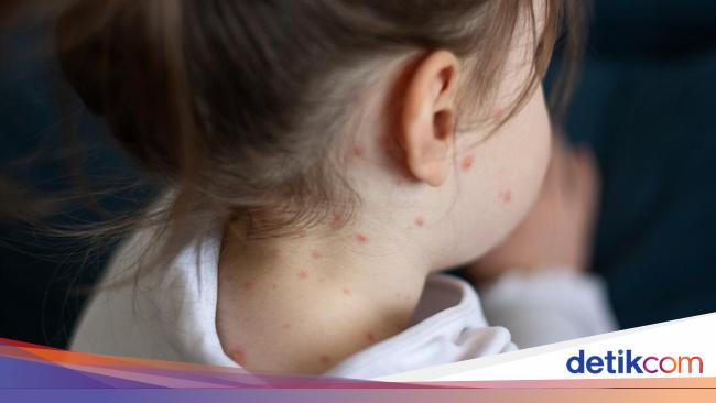 Kasus Suspek Campak Di Pohuwato Meningkat: Dinkes Gorontalo Ungkap Penyebabnya Kasus Suspek Campak Di Pohuwato Meningkat: Dinkes Gorontalo Ungkap Penyebabnya