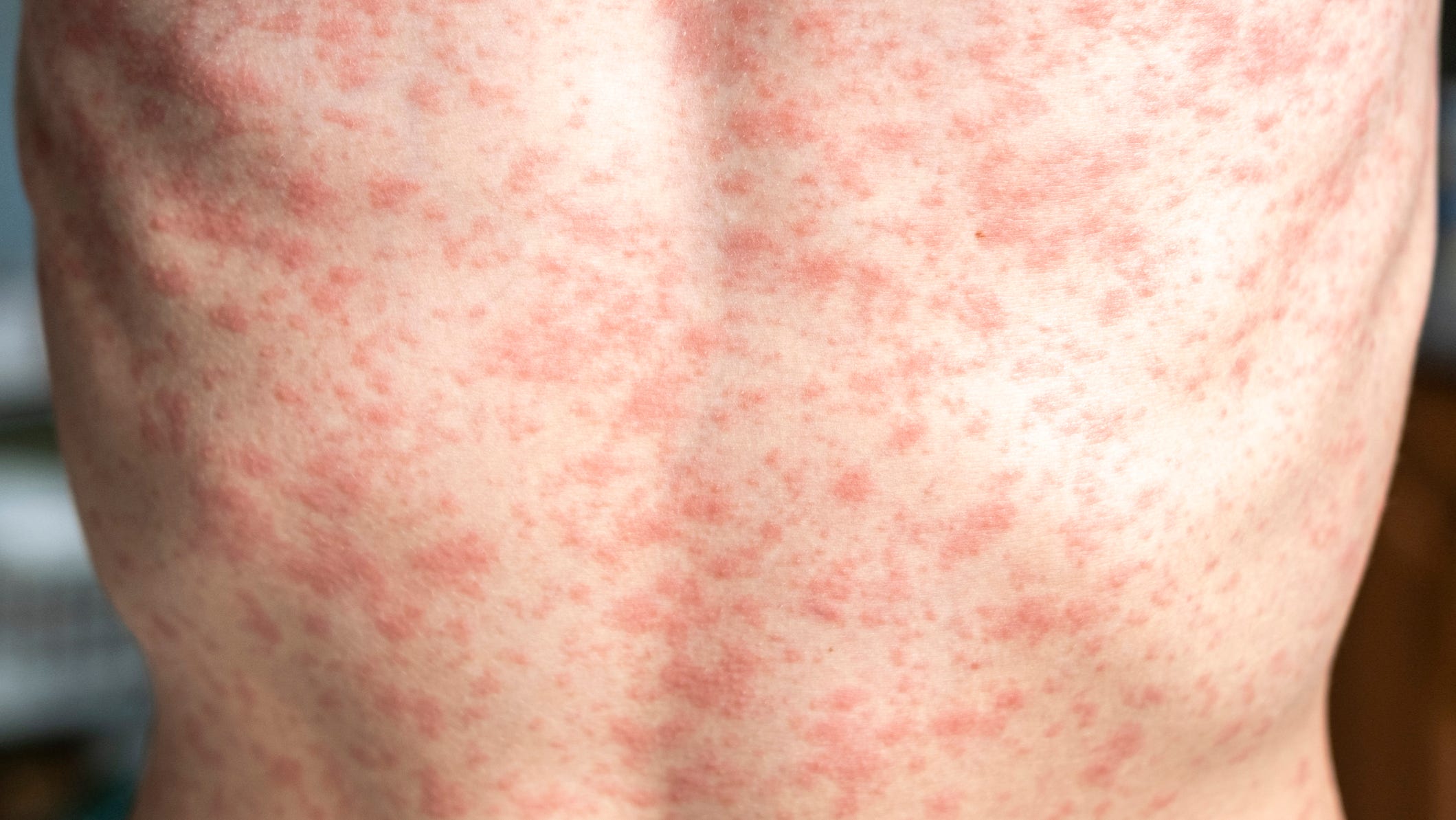 Measles Cases Rise In Israel Linked To Texas Outbreak Measles Cases Rise In Israel Linked To Texas Outbreak