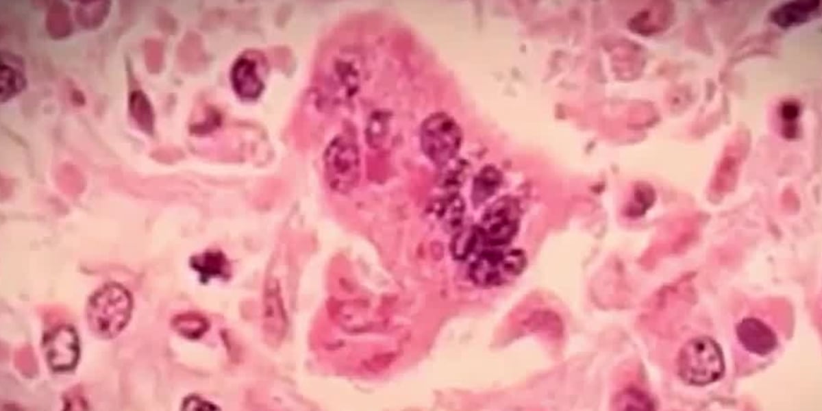Measles In Kansas: A Detailed Analysis Of The Recent Increase Measles In Kansas: A Detailed Analysis Of The Recent Increase