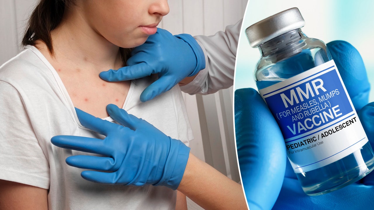 Update: Second Measles Case Reported In Virginia For 2025 Update: Second Measles Case Reported In Virginia For 2025